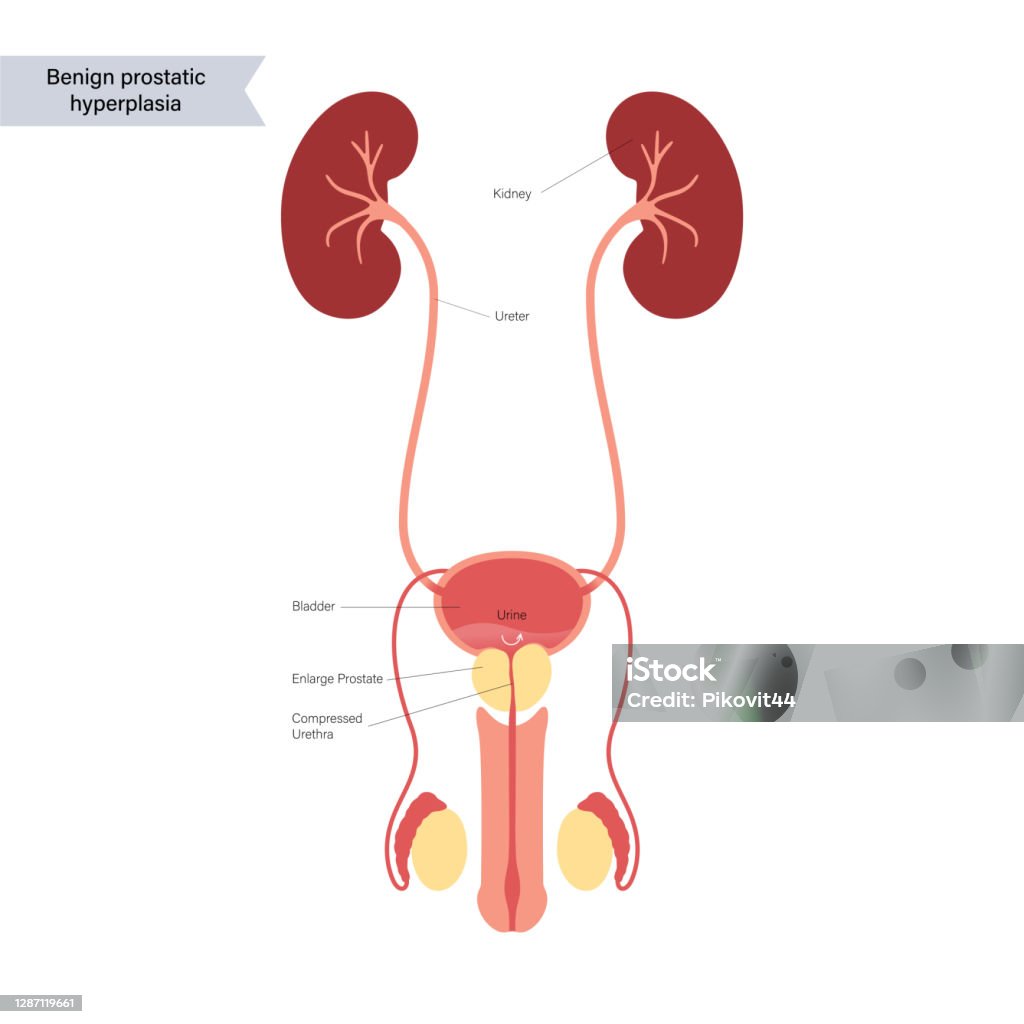 Bph Explained Bph Info Concept Stock Illustration - Download Image Now - People ...