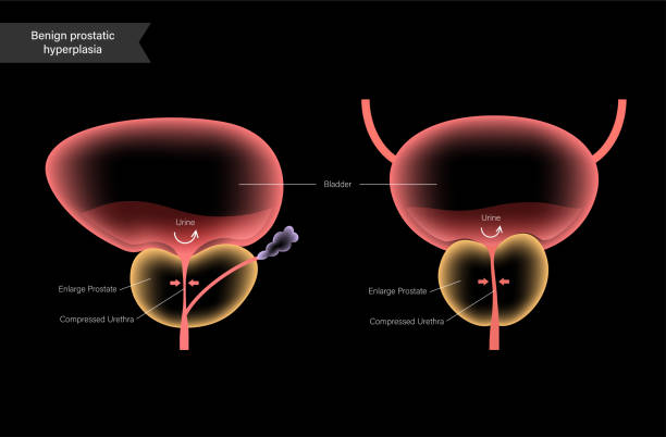 Bph Explained 30+ Prostate Anatomy Diagram Background Stock Illustrations, Royalty ...