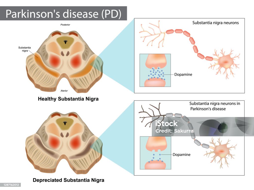 Parkinson's disease. Normal and Depreciated Substantia Nigra Parkinson's disease (PD). Normal and Depreciated Substantia Nigra Parkinson's Disease stock vector