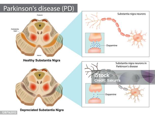 Parkinsons Disease Normal And Depreciated Substantia Nigra Stock Illustration - Download Image Now