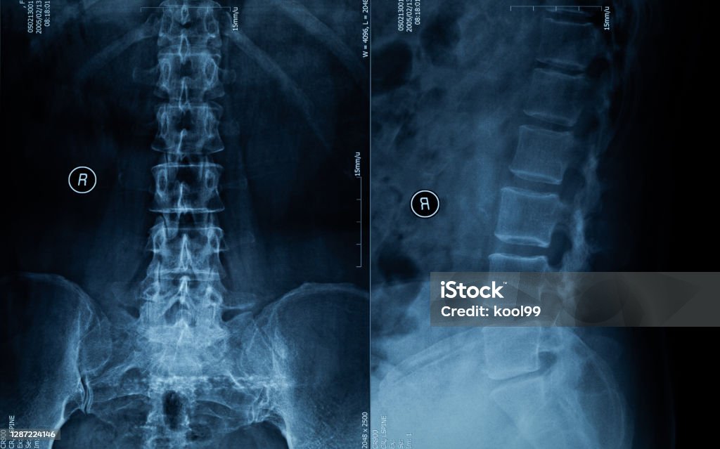 Spine X-ray Film X-ray Image Stock Photo