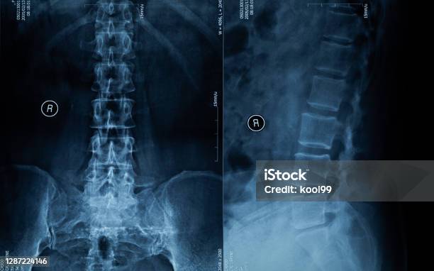 Spine Xray Film Stock Photo - Download Image Now - X-ray Image, Spine - Body Part, CAT Scan