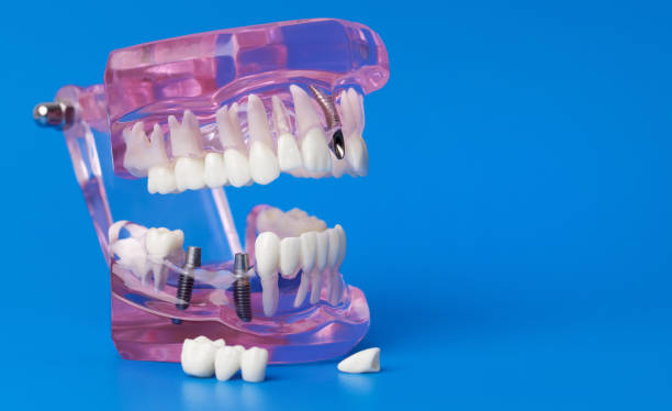istock human jaw tooth model with dental implants on blue background with copy space 1287277590