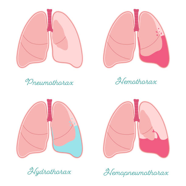 20+ Grafiken, lizenzfreie und Clipart zu Pleuraspalt