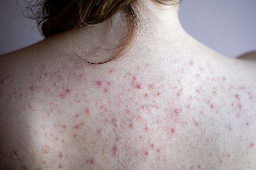 mujer de nuevo con acné, manchas rojas, enfermedad de la piel photo