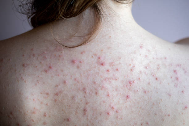 woman back with acne, red spots, skin disease woman back with acne, red spots, skin disease. High quality photo pimple stock pictures, royalty-free photos & images