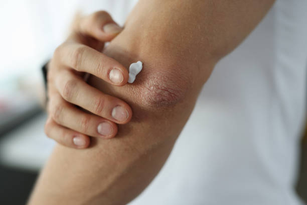 Man applying protective cream to damaged skin of elbow close-up Man applying protective cream to damaged skin of elbow close-up. Psoriasis treatment concept psoriasis stock pictures, royalty-free photos & images