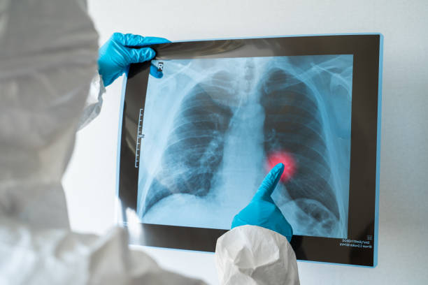 istock Scientist, Microbiologist or Dotor checking examining viral infection or pneumonia lesion on Chest X-ray film in laboratory with biological tube for analysis and sampling of Coronavirus 2019,COVID-19 1287891275