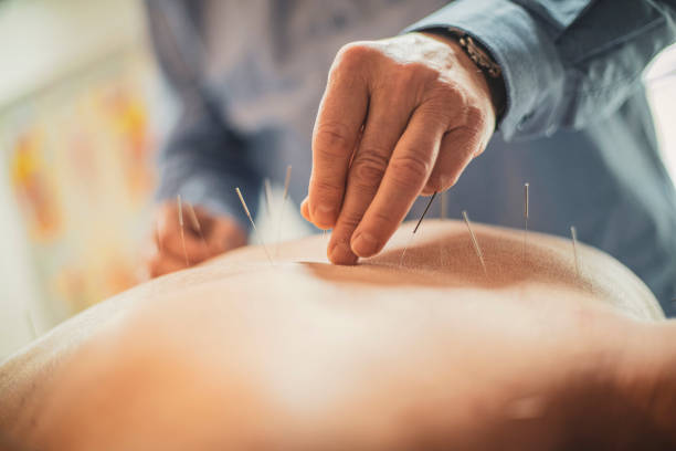 istock Trying out the acupuncture 1287984551