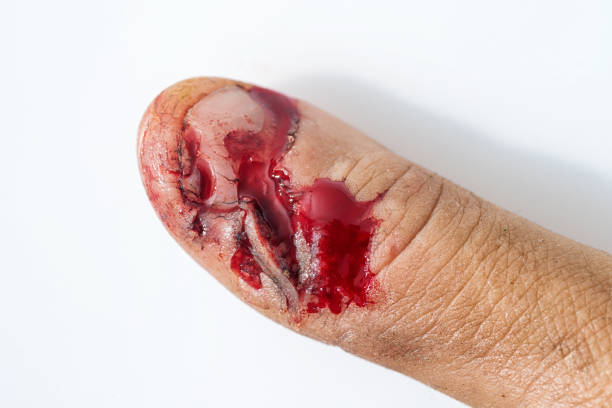 物理的傷害血液傷ヒト手指爪 - wound blood human finger physical injury ストックフォトと画像