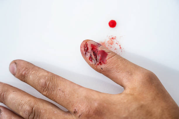 物理的傷害血液傷ヒト手指爪 - wound blood human finger physical injury ストックフォトと画像