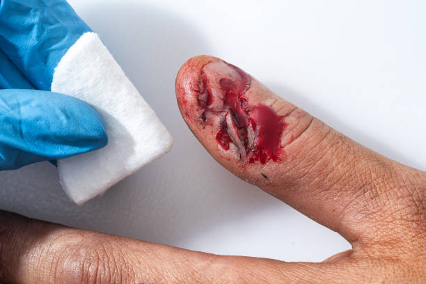 物理的傷害血液傷ヒト手指爪 - wound blood human finger physical injury ストックフォトと画像