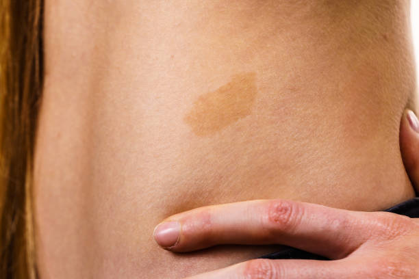 istock Closeup of brown birthmark on skin 1288060355