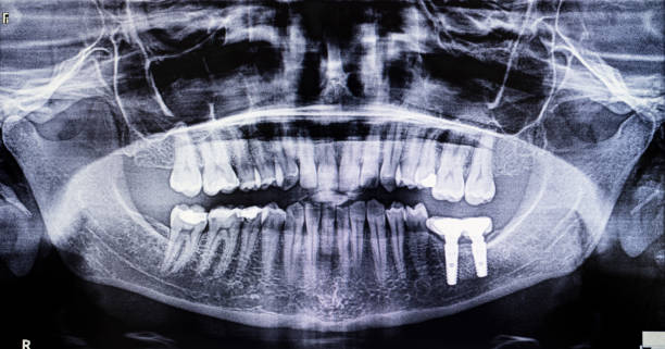 歯科用詰め物とインプラントを示す歯科用x線 - 歯 写真 ストックフォトと画像