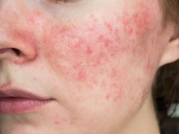 Photo of papulopustular rosacea, close-up of the patient's cheek