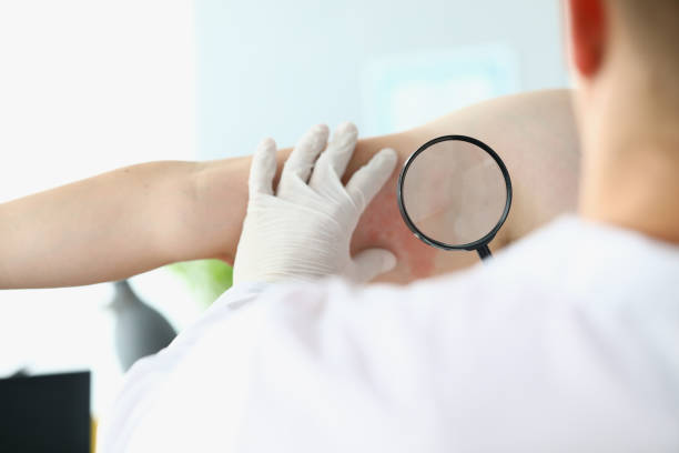 istock Doctor examines through magnifying glass allergic reaction on man hand. 1288091178