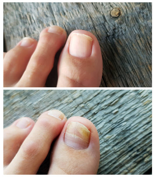 close-up de um pé com fungo de unha em um fundo de madeira. colagem. tratamento de unha antes e depois. onycholysis: desprendimento da unha da cama de unha. - podiatry chiropody women pedicure - fotografias e filmes do acervo