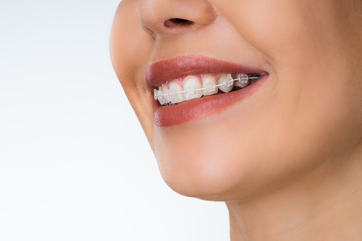 Boca femenina con corros dentales metálicos blancos photo