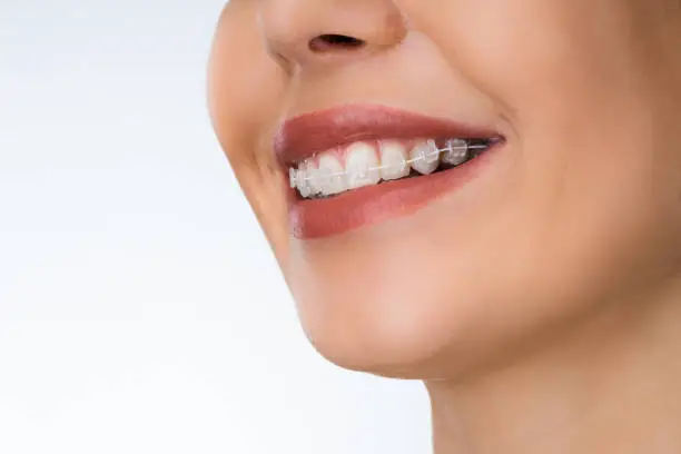 Female Mouth With Metal White Dental Braces Or Brackets