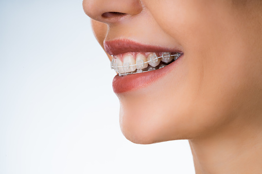 Boca femenina con corros dentales metálicos blancos photo