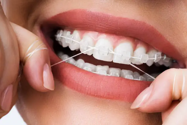 Female Cleaning Dental Brackets In Mouth Using Floss