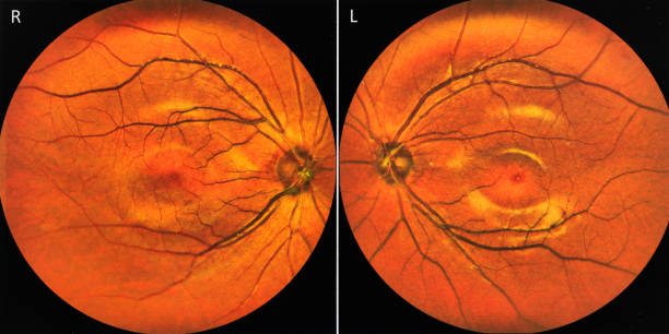 Human optic disc, retina and blood vessels Human optic disc, retina and blood vessels cornea photos stock pictures, royalty-free photos & images