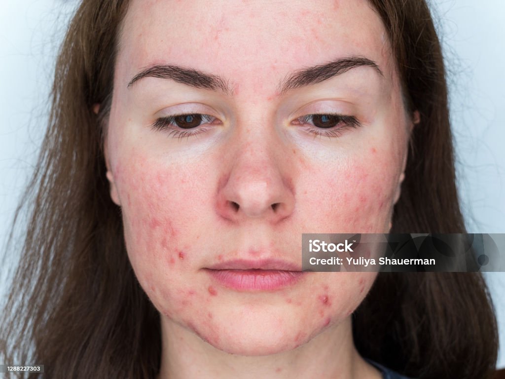 papulopustular rosacea, Nahaufnahme des Gesichts des Patienten - die Folgen des längeren Tragens einer Maske - Lizenzfrei Akne Stock-Foto