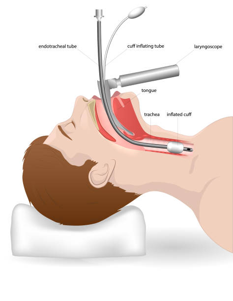 illustrazioni stock, clip art, cartoni animati e icone di tendenza di intubazione per un paziente con arresto respiratorio o difficoltà respiratorie - intubazione
