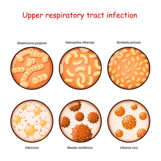 Vector illustration of respiratory infection