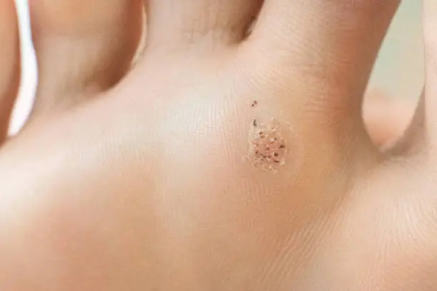 wart on a blunt close-up. Macro shot of human papilloma on the foot