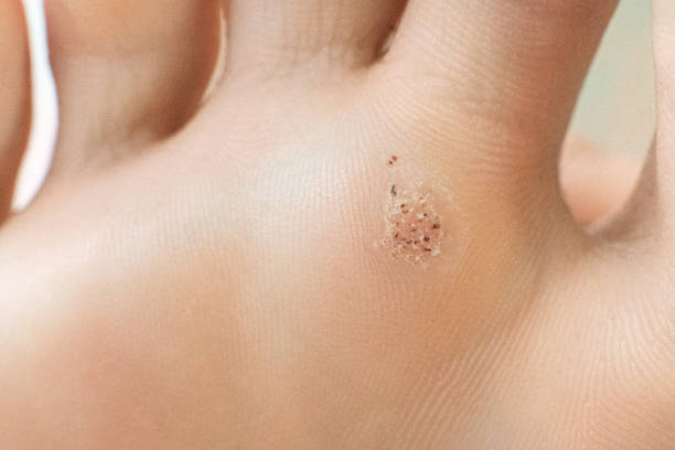 verruga em um close-up contundente. tiro macro de papiloma humano no pé - verruga plantar - fotografias e filmes do acervo