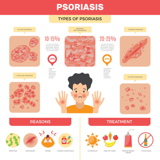 illustrations, cliparts, dessins animés et icônes de infographie sur le psoriasis. images médicales de diagnostic de psoriasis d’infection de peau humaine - psoriasis