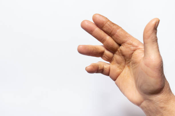 Human hand brush on a white background - a disease of the joint and palm, Dupuytren's contracture, fingers do not bend. Medicine and traumatology, orthopedics stock photo
