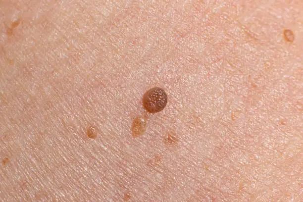 Photo of Papilloma on human skin - benign tumor in the form of mole, nevus Papillomatosis medicine