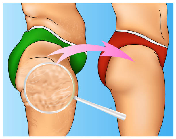 Realistic colorful illustration of woman cellulite Realistic colorful illustration of woman cellulite with arrow designation and magnifying glass cellulite stock illustrations