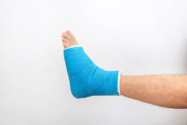 istock Man's leg in plaster cast and blue splint close up on white background. 1288775504