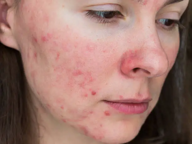 papulopustular rosacea, close-up of the patient's cheek - the consequences of prolonged wearing of a mask