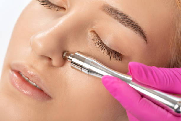 bella ragazza con la pelle fresca pulita. il cosmetologo effettua la microdermabrasione della procedura sul viso contro l'acne e i punti neri sul naso. cosmetologia femminile nel salone di bellezza. - dermatology dermabrasion surgery medical foto e immagini stock