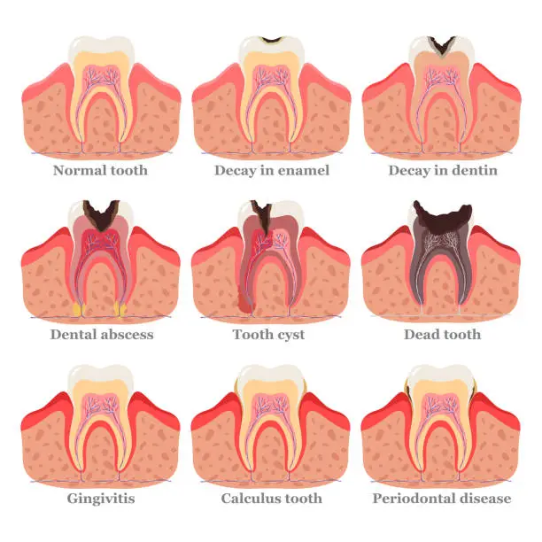 Vector illustration of Tooth disorders set, flat vector illustration. Healthy and unhealthy teeth. Dental problems and diseases.