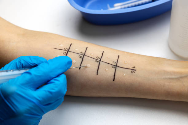 istock immunologist doing skin prick allergy test on a patient arm 1288998568