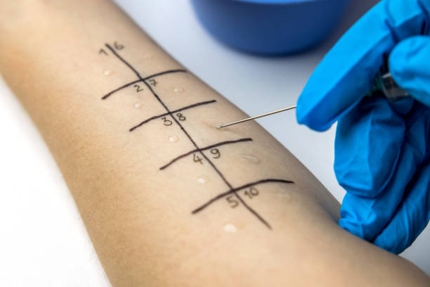 allergist doing skin prick allergy test on a patient arm closeup allergist doing skin prick allergy test on a patient arm closeup allergy test stock pictures, royalty-free photos & images