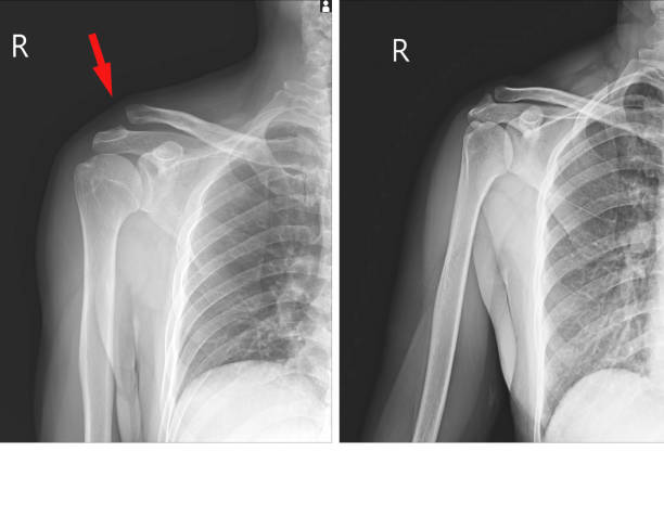 x線右肩の溶出 rt.acromioclavicular関節(ac)傷害および正常関節の、軟部組織の中程度の腫脹。 - shoulder pain physical injury human arm ストックフォトと画像