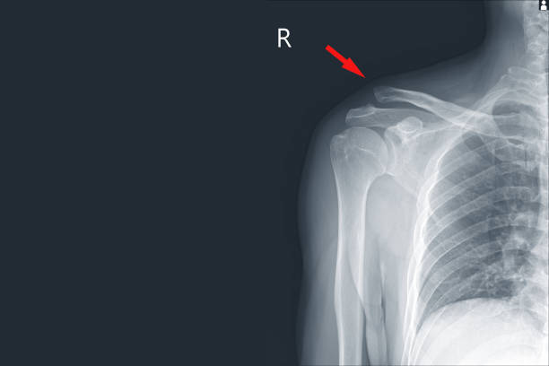 x-ray right shoulder subluation of rt.acromioclavicular joint(ac) injury on red point,moderate swelling of soft tissue. - pain rib cage x ray image chest imagens e fotografias de stock