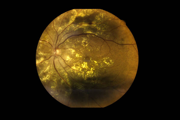 vista all'interno dei disturbi oculari umani che mostrano retina, nervo ottico e macula grave degenerazione maculare legata all'età. immagine medica retina anomala - vein field foto e immagini stock