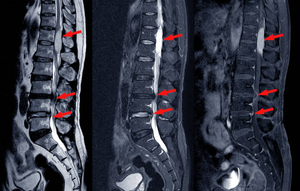 MRI scan of lumbar spines of a patient finding Spinal mass at Lt.side T12-L1 level Severe bulging disc L3-4 causing bilateral L4 nerve root compression and spinal stenosis on arrow point. MRI scan of lumbar spines of a patient finding Spinal mass at Lt.side T12-L1 level Severe bulging disc L3-4 causing bilateral L4 nerve root compression and spinal stenosis on arrow point. Spinal Stenosis stock pictures, royalty-free photos & images