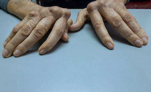Mature female patient with rheumatoid osteoarthritis