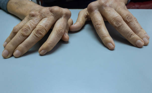 Mature female patient with rheumatoid osteoarthritis stock photo