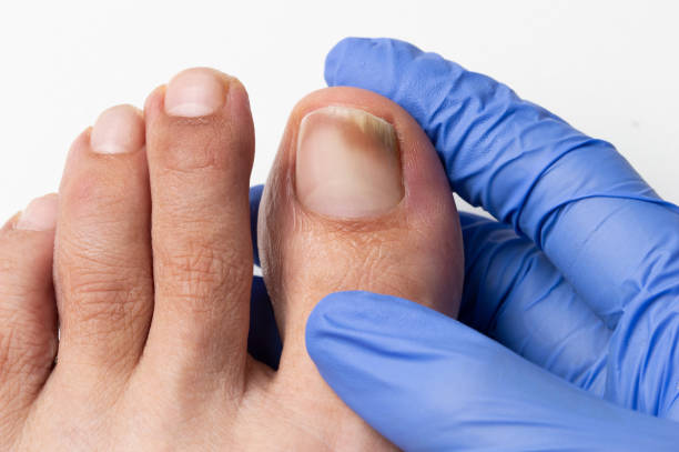 checking the damaged toenail Close-up image of the doctor who controls the left toe that suffers a fungus nail fungus stock pictures, royalty-free photos & images