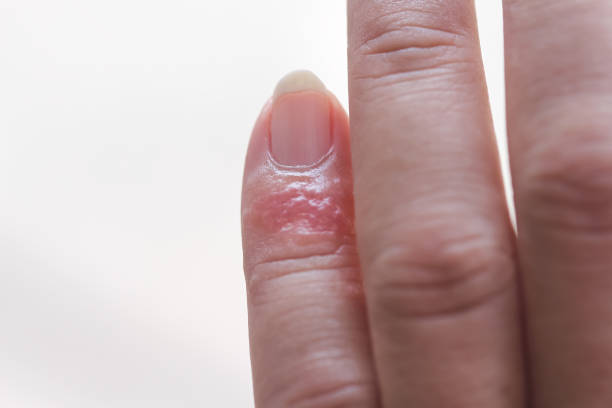 istock Rash allergy Inflammation on little finger 1289112165