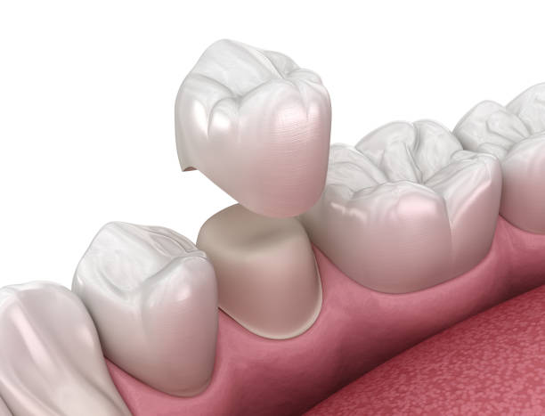 istock Preparated premolar tooth and dental crown placement. Medically accurate 3D illustration 1289167696